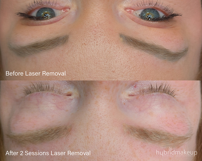 Laser Brow Removal